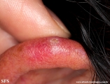 chondrodermatitis nodularis chronica helicis
