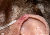 chondrodermatitis nodularis chronica helicis