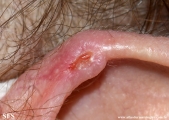 chondrodermatitis nodularis chronica helicis