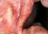 chondrodermatitis nodularis chronica helicis
