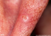 chondrodermatitis nodularis chronica helicis