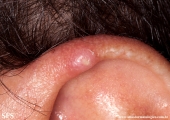 chondrodermatitis nodularis chronica helicis
