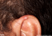 chondrodermatitis nodularis chronica helicis