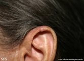 chondrodermatitis nodularis chronica helicis