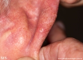 chondrodermatitis nodularis chronica helicis