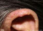 chondrodermatitis nodularis chronica helicis