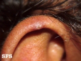 chondrodermatitis nodularis chronica helicis