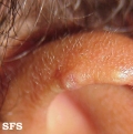 chondrodermatitis nodularis chronica helicis