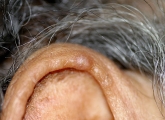chondrodermatitis nodularis chronica helicis