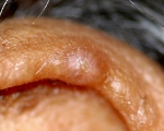 chondrodermatitis nodularis chronica helicis