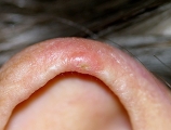 chondrodermatitis nodularis chronica helicis