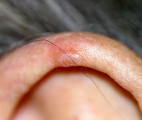 chondrodermatitis nodularis chronica helicis