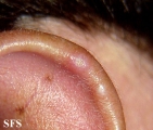chondrodermatitis nodularis chronica helicis
