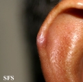 chondrodermatitis nodularis chronica helicis