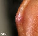 chondrodermatitis nodularis chronica helicis