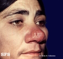 rhinoscleroma