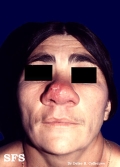 rhinoscleroma