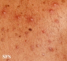 tuberculid