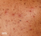 tuberculid