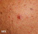 tuberculid