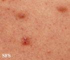 tuberculid