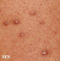 tuberculid