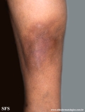 lipodermatosclerosis