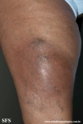 lipodermatosclerosis
