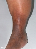 lipodermatosclerosis