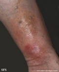 lipodermatosclerosis