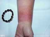 contact dermatitis