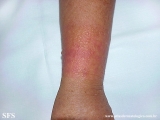 contact dermatitis