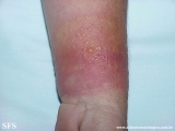 contact dermatitis