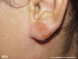 contact dermatitis