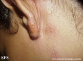 contact dermatitis