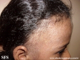 contact dermatitis