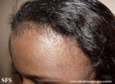 contact dermatitis
