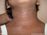 contact dermatitis