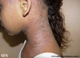 contact dermatitis