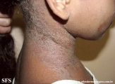 contact dermatitis