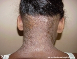 contact dermatitis