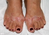 contact dermatitis