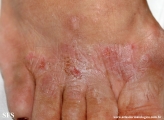 contact dermatitis
