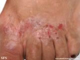 contact dermatitis