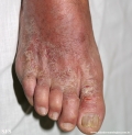 contact dermatitis
