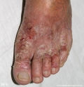 contact dermatitis