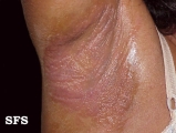 contact dermatitis