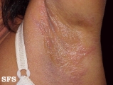contact dermatitis