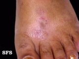 contact dermatitis