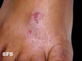 contact dermatitis